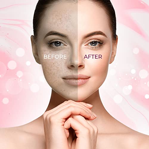 Tamno sredstvo za uklanjanje tačaka za lice, proizvedeno u SAD tretman hiperpigmentacije, Acne Spot, Melasma,Freckle, Sun Spot Remover,